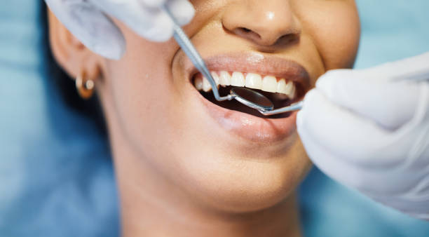 Best Emergency Dental Care for Broken or Chipped Teeth in Buckley, WA